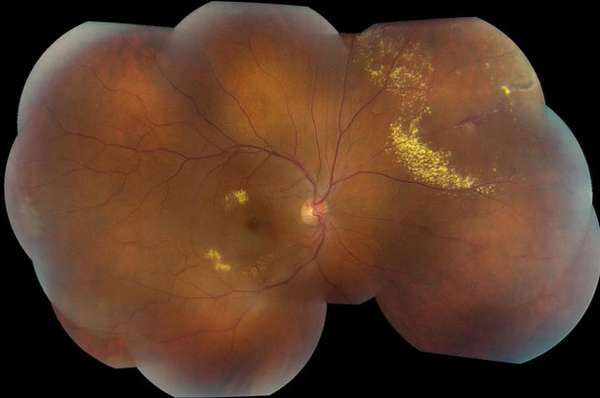 сетчатки при ретините коатса